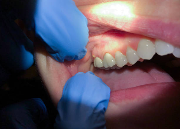 Best Emergency Dental Care for Abscessed Tooth in Colfax, IL